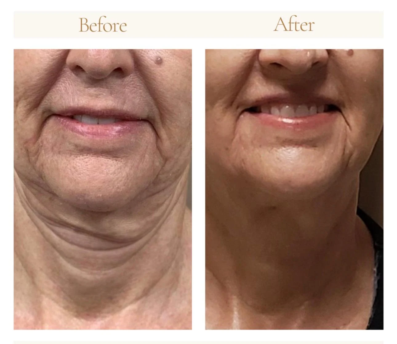 Before-and-after example published on Rejuvify’s Morpheus8 page: Lower face & neck