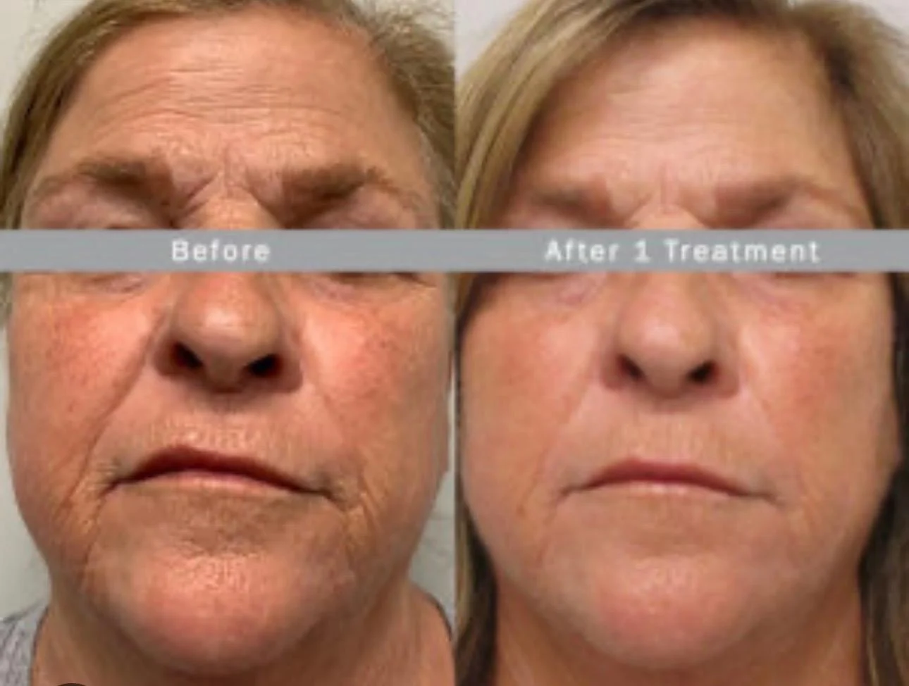 Before-and-after example published on Rejuvify’s Morpheus8 page: Face & skin texture