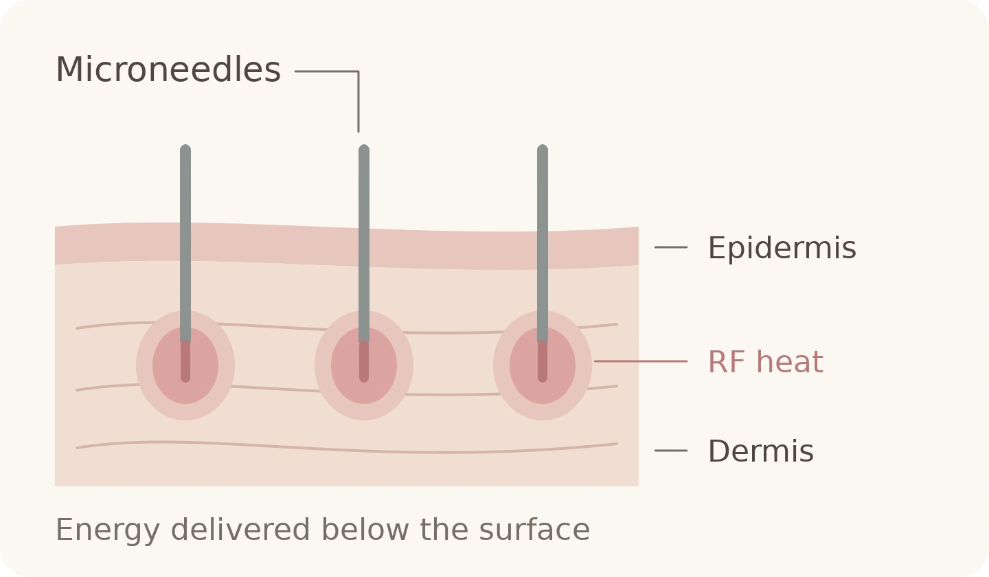 Diagram of microneedles crossing the epidermis, with local RF heating around the needle tips in the dermis.